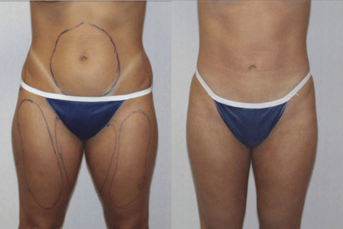 Before and after liposuction, front view of the abdomen and thighs — Dr. Rudderman, Atlanta.