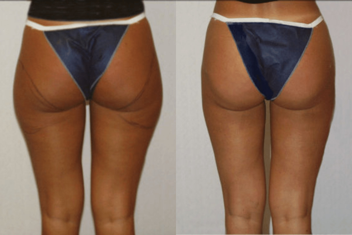 Before and after liposuction, back view of the buttocks and thighs — Dr. Rudderman, Atlanta.