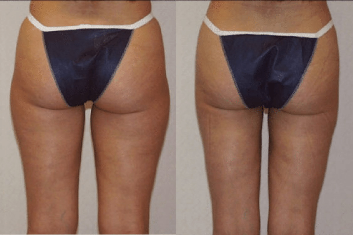 Before and after liposuction, back view of the buttocks and thighs — Dr. Rudderman, Atlanta.