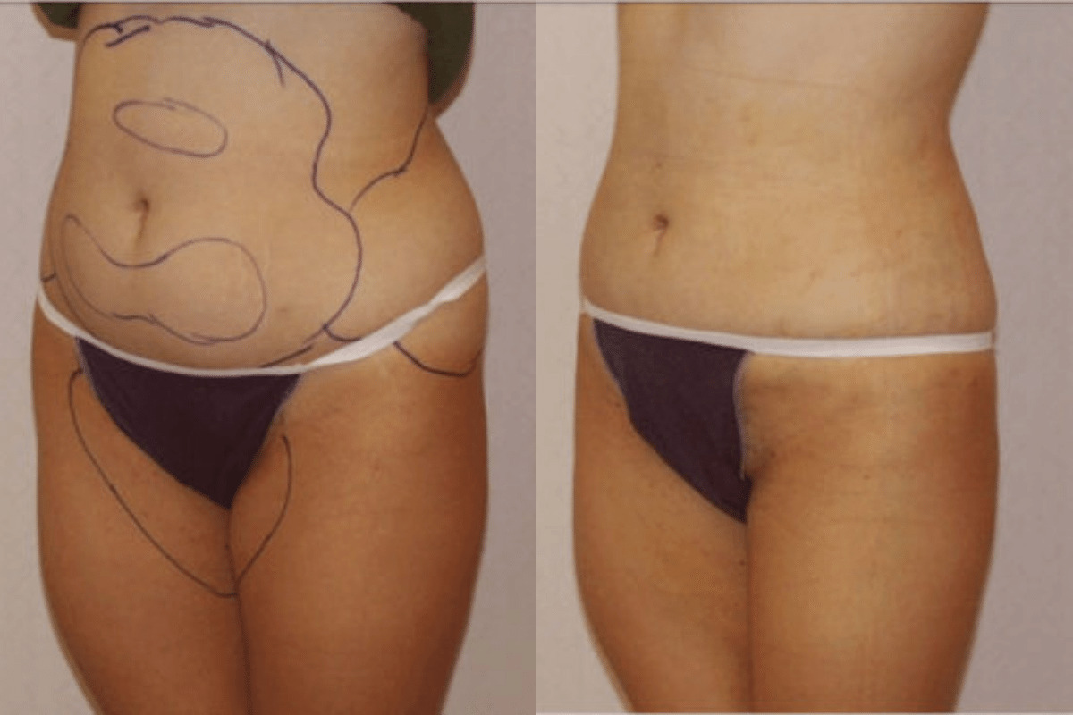 Before and after liposuction, three-quarter view of the abdomen and flanks — Dr. Rudderman, Atlanta.