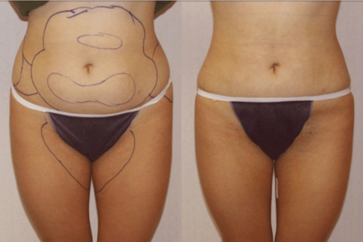 Before and after liposuction, front view of the abdomen — Dr. Rudderman, Atlanta.