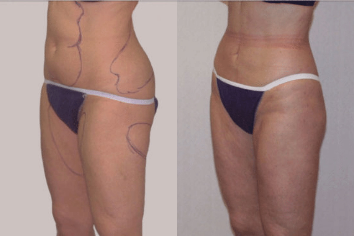 Before and after liposuction, side profile view of the abdomen and thighs — Dr. Rudderman, Atlanta.