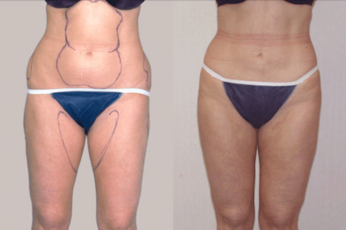 Before and after liposuction, front view of the abdomen and thighs — Dr. Rudderman, Atlanta.