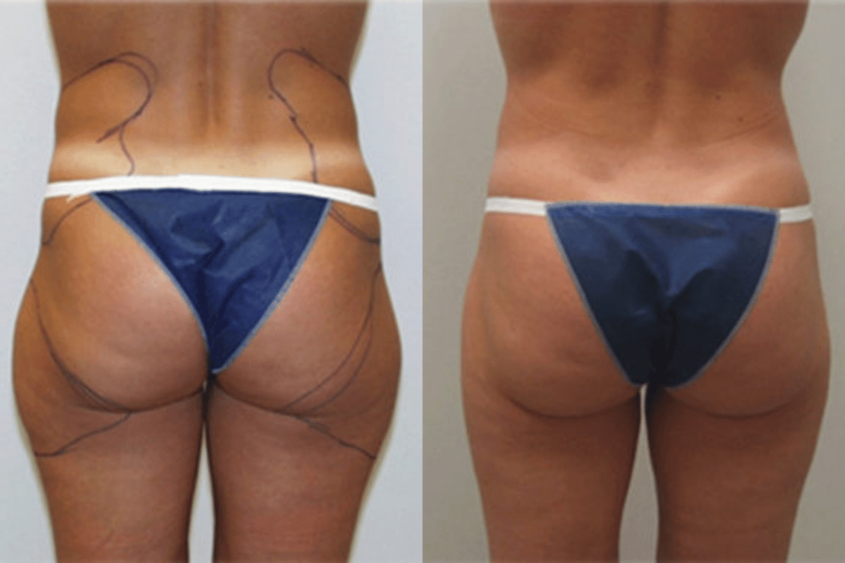 Before and after liposuction, back view of the buttocks and thighs — Dr. Rudderman, Atlanta.