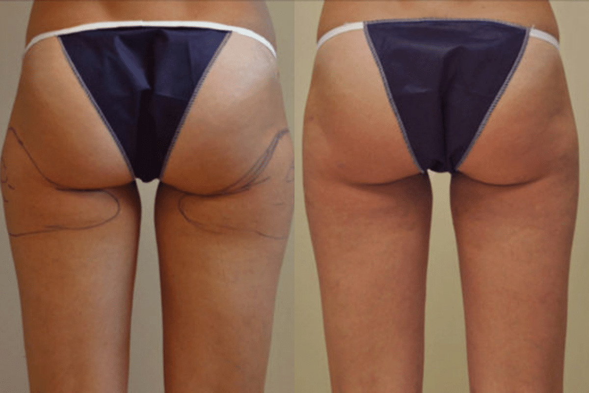 Before and after liposuction, back view of the buttocks and thighs — Dr. Rudderman, Atlanta.