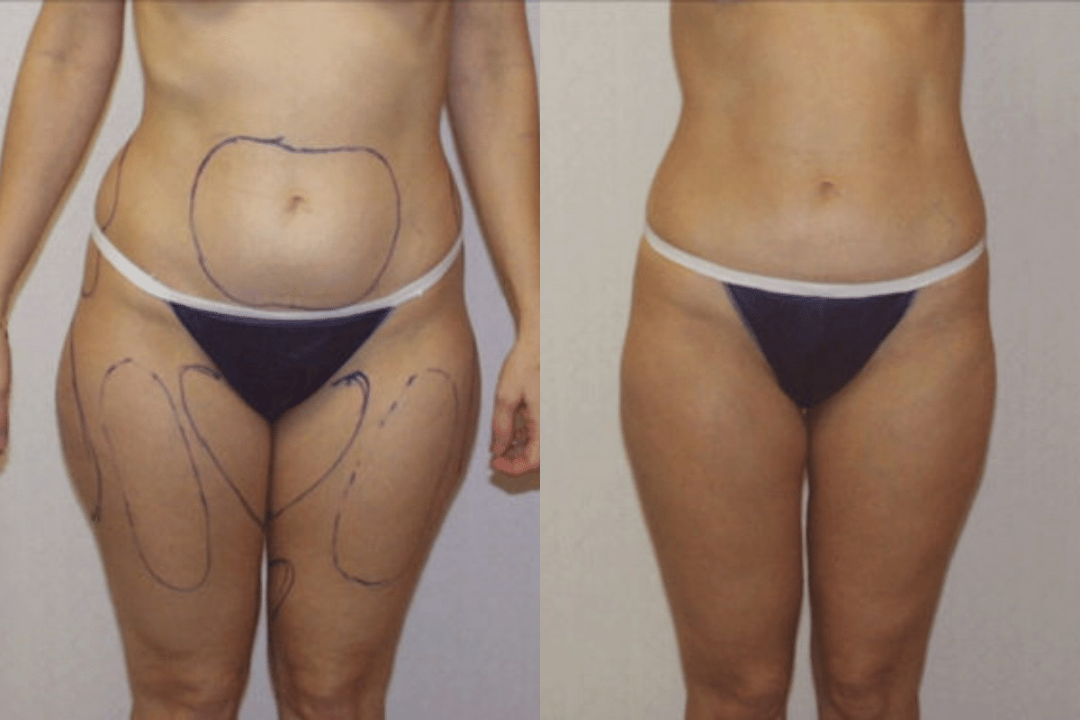 Before and after liposuction, front view of the abdomen and thighs — Dr. Rudderman, Atlanta.