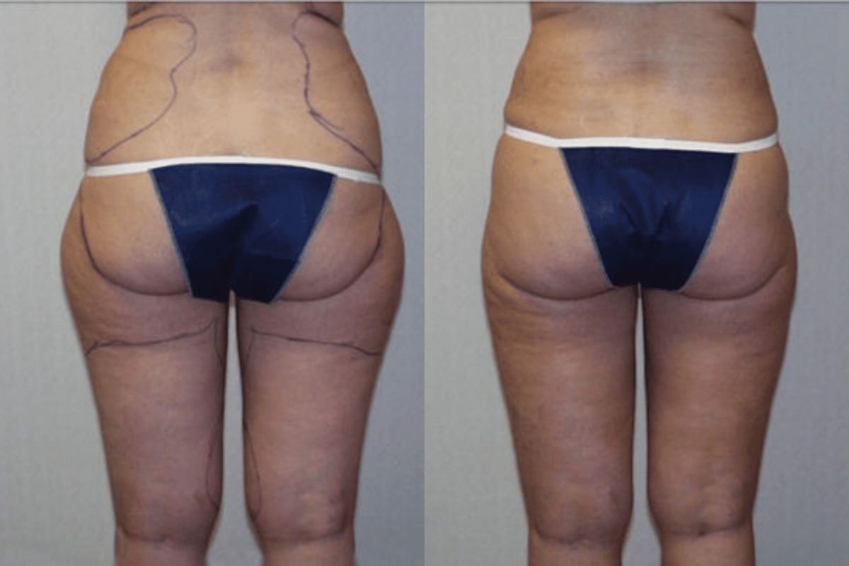 Before and after liposuction, back view of the buttocks and thighs — Dr. Rudderman, Atlanta.