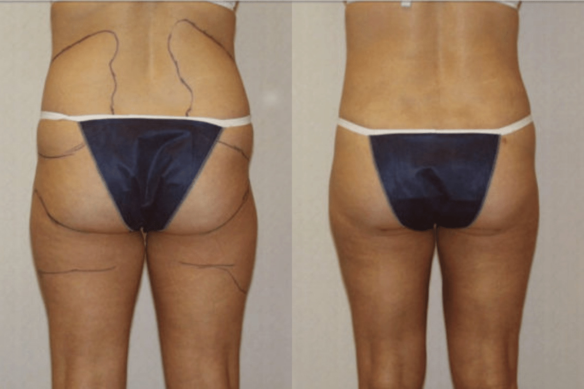 Before and after liposuction, back view of the buttocks and thighs — Dr. Rudderman, Atlanta.