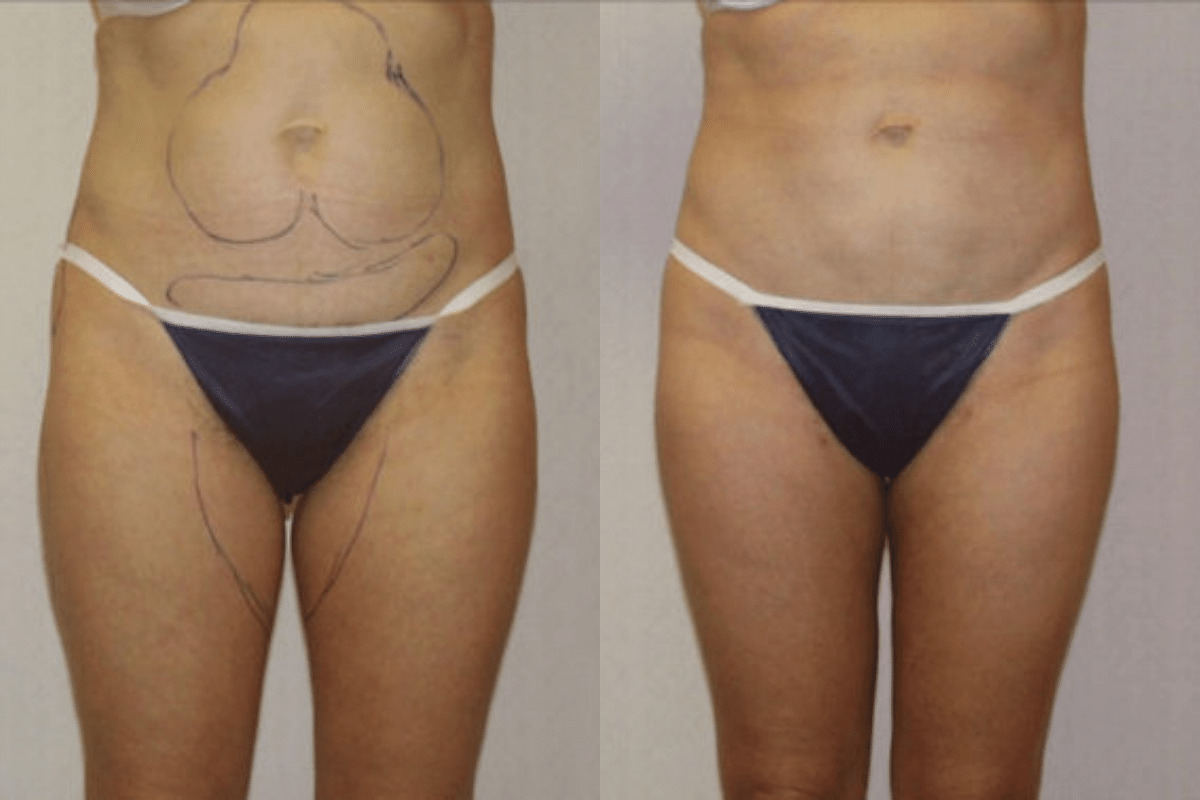 Before and after liposuction, front view of the abdomen and thighs — Dr. Rudderman, Atlanta.