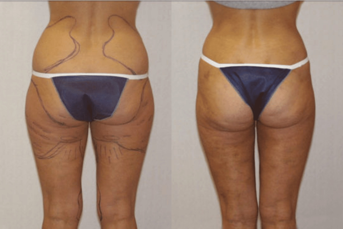Before and after liposuction, back view of the buttocks and thighs — Dr. Rudderman, Atlanta.