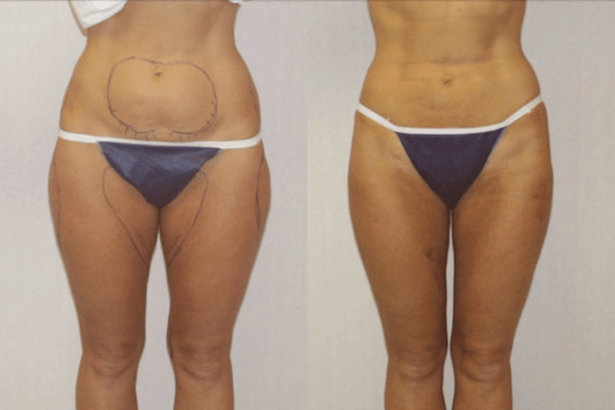 Before and after liposuction, front view of the abdomen and thighs — Dr. Rudderman, Atlanta.