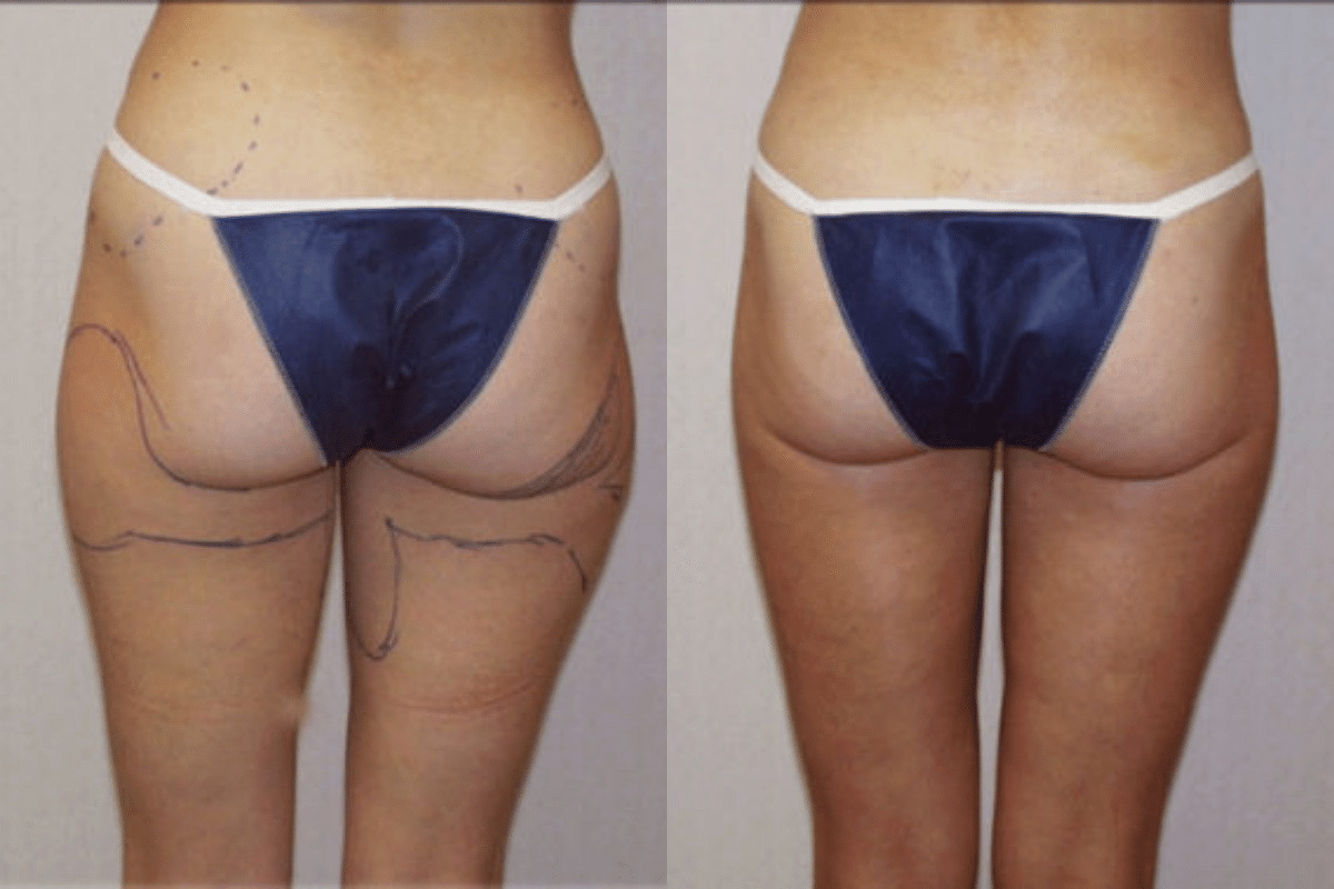 Before and after liposuction, back view of the buttocks and thighs — Dr. Rudderman, Atlanta.