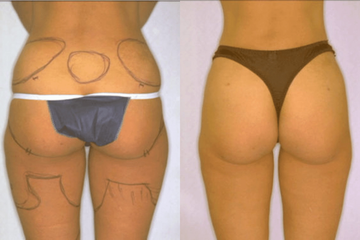 Before and after liposuction, back view of the buttocks and thighs — Dr. Rudderman, Atlanta.