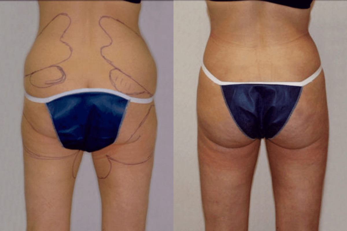 Before and after liposuction, back view of the buttocks and thighs — Dr. Rudderman, Atlanta.