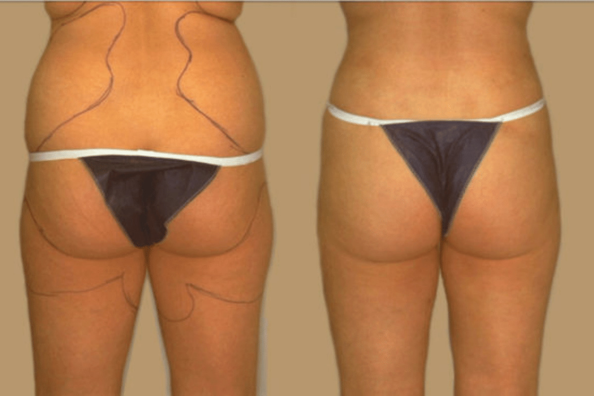 Before and after liposuction, back view of the buttocks and thighs — Dr. Rudderman, Atlanta.