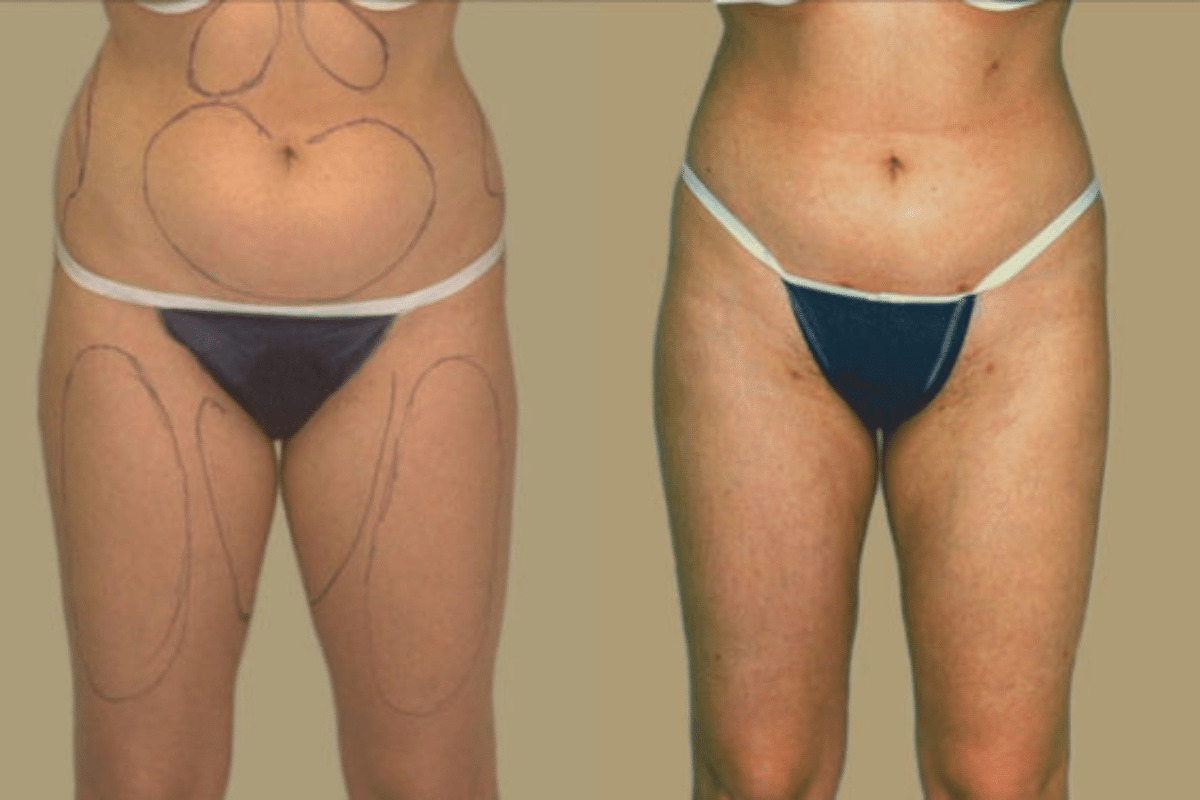 Before and after liposuction, front view of the abdomen and thighs — Dr. Rudderman, Atlanta.