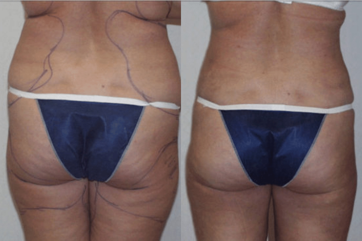 Before and after liposuction, back view of the buttocks and thighs — Dr. Rudderman, Atlanta.