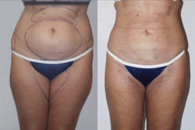 Before and after liposuction, front view of the abdomen and thighs — Dr. Rudderman, Atlanta.