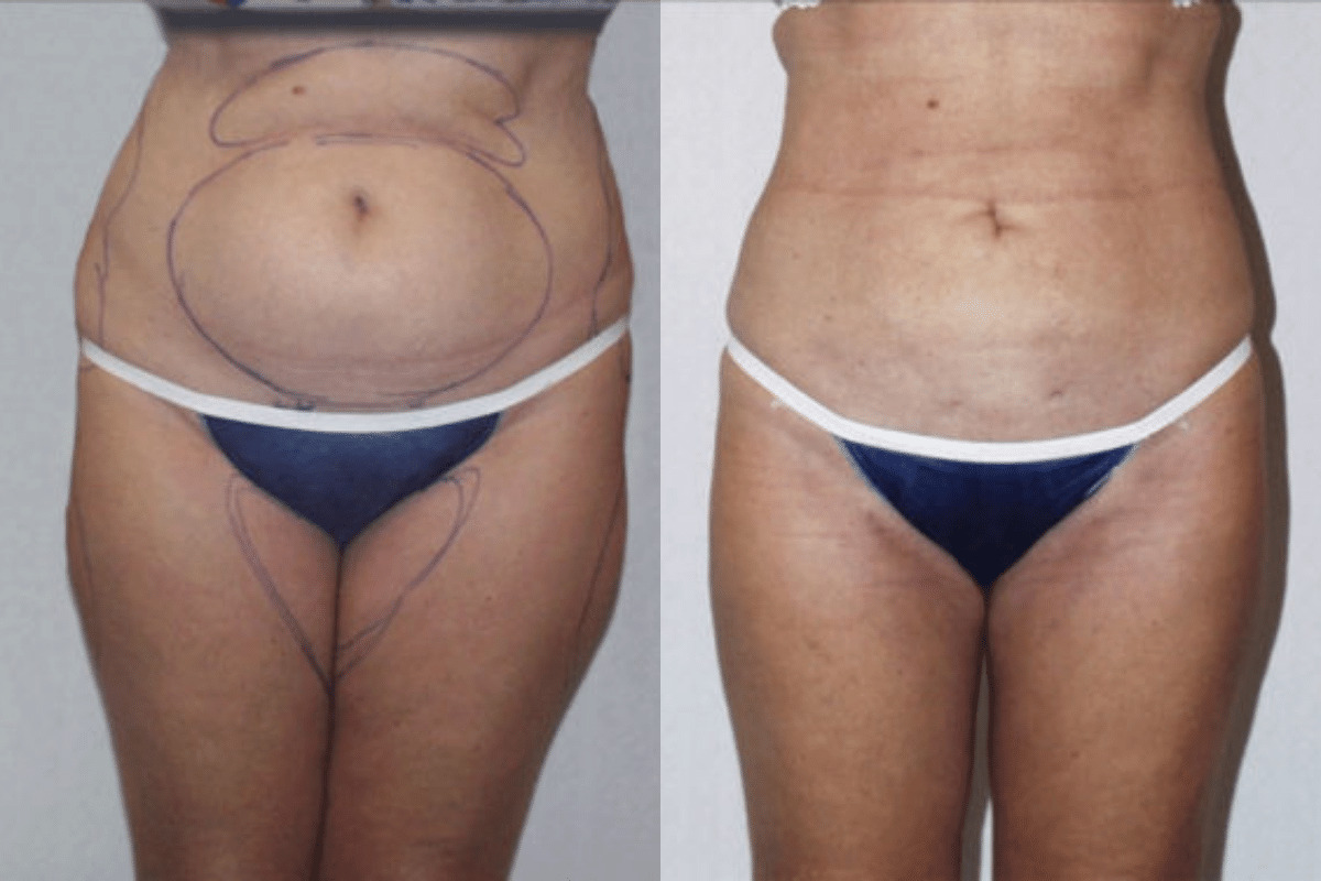 Before and after liposuction, front view of the abdomen and thighs — Dr. Rudderman, Atlanta.
