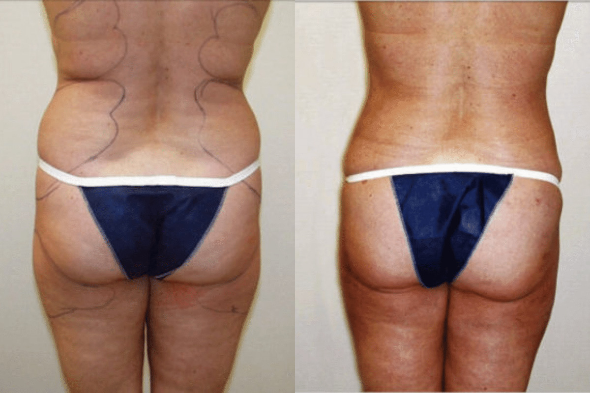 Before and after liposuction, back view of the buttocks and thighs — Dr. Rudderman, Atlanta.