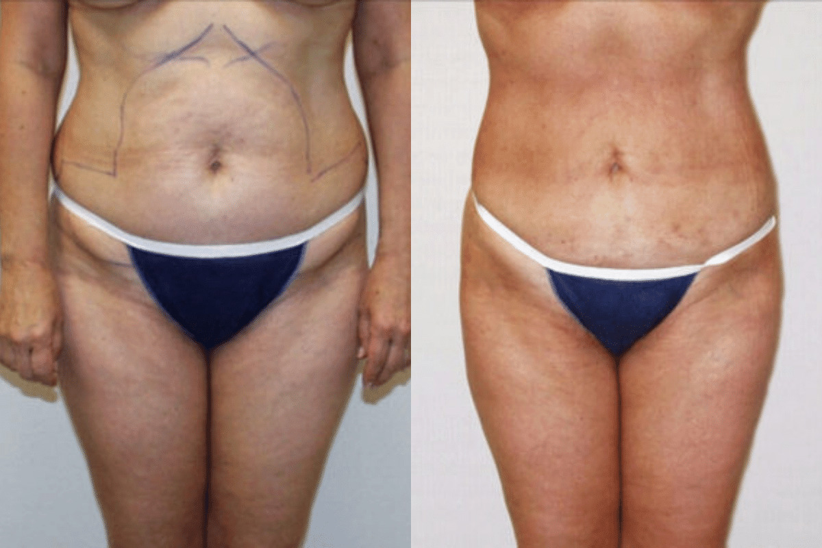 Before and after liposuction, front view of the abdomen — Dr. Rudderman, Atlanta.