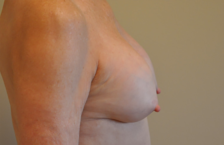 Breast revision patient photo, side profile view of the breasts — Dr. Rudderman, Atlanta.