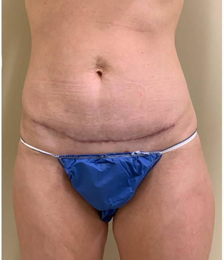 Abdomen after mini tummy tuck, front view — Dr. Rudderman, Atlanta.