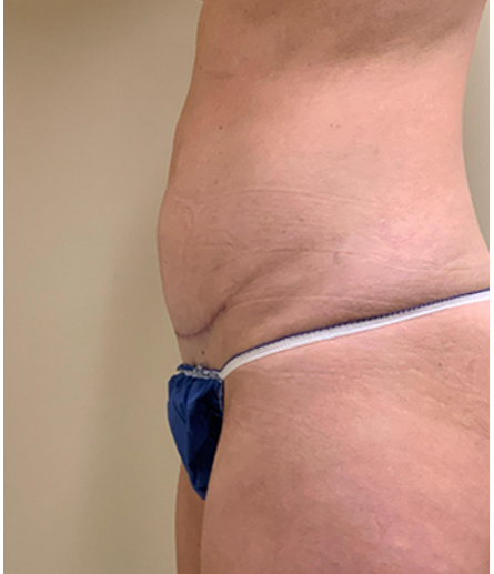 Mini tummy tuck patient photo, side profile view of the abdomen — Dr. Rudderman, Atlanta.