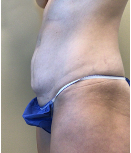 Abdomen before mini tummy tuck, side profile view — Dr. Rudderman, Atlanta.