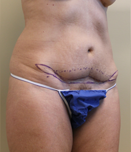 Abdomen with pre-surgical markings before mini tummy tuck, three-quarter view — Dr. Rudderman, Atlanta.