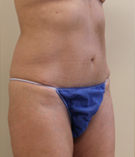 Mini tummy tuck patient photo, three-quarter view of the abdomen — Dr. Rudderman, Atlanta.