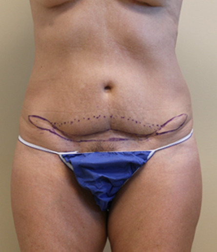 Abdomen with pre-surgical markings before mini tummy tuck, front view — Dr. Rudderman, Atlanta.