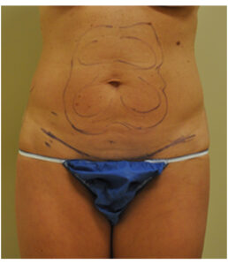Abdomen with pre-surgical markings before mini tummy tuck, front view — Dr. Rudderman, Atlanta.