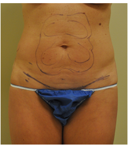 Abdomen with pre-surgical markings before mini tummy tuck, front view — Dr. Rudderman, Atlanta.