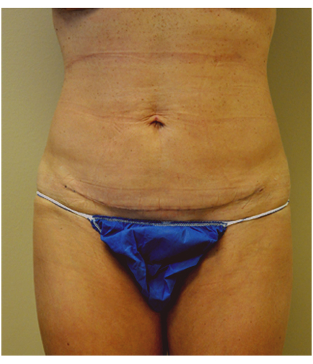 Abdomen after mini tummy tuck, front view — Dr. Rudderman, Atlanta.