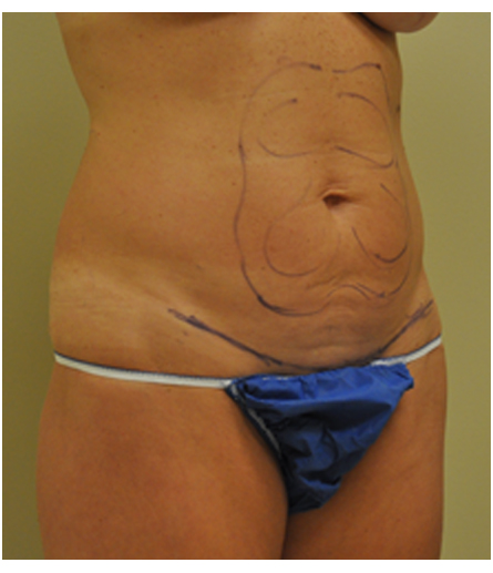 Abdomen with pre-surgical markings before mini tummy tuck, three-quarter view — Dr. Rudderman, Atlanta.
