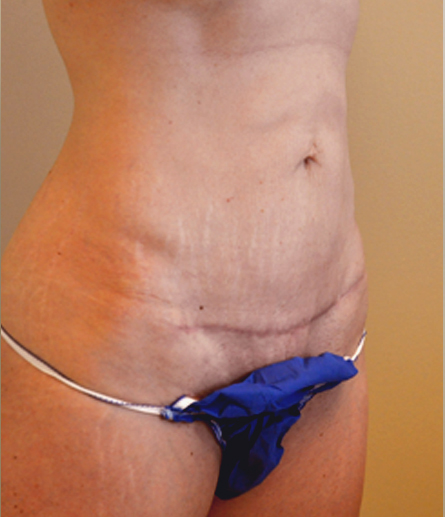 Abdomen after mini tummy tuck, three-quarter view — Dr. Rudderman, Atlanta.