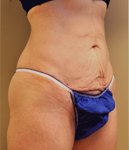 Abdomen before mini tummy tuck, three-quarter view — Dr. Rudderman, Atlanta.