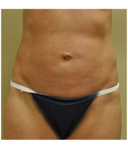 Mini tummy tuck patient photo, front view of the abdomen — Dr. Rudderman, Atlanta.