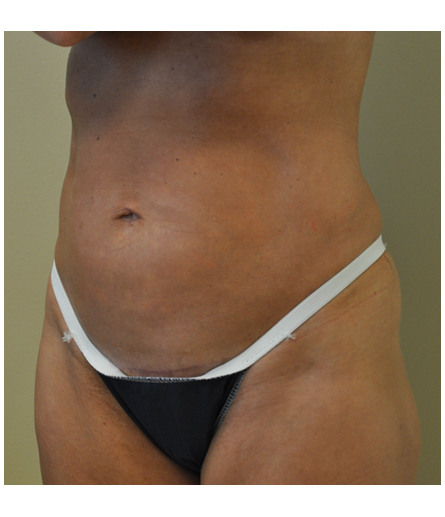Mini tummy tuck patient photo, three-quarter view of the abdomen — Dr. Rudderman, Atlanta.