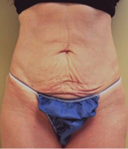Abdomen before mini tummy tuck, front view — Dr. Rudderman, Atlanta.