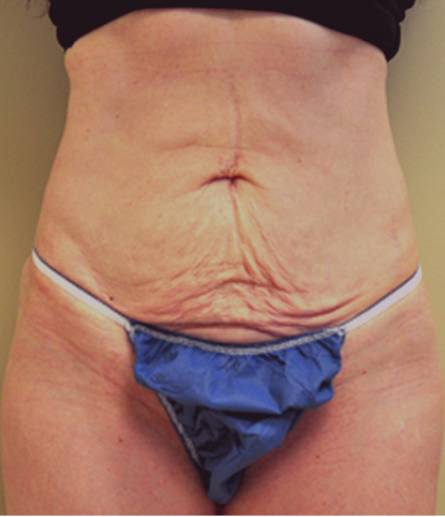 Abdomen before mini tummy tuck, front view — Dr. Rudderman, Atlanta.