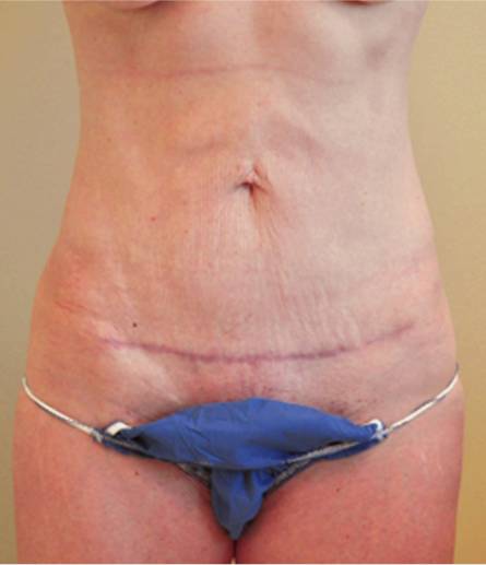 Abdomen after mini tummy tuck, front view — Dr. Rudderman, Atlanta.