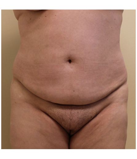 Pubic area before pubic lift, front view — Dr. Rudderman, Atlanta.