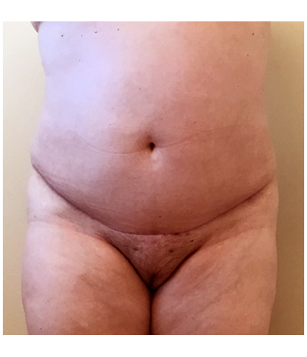 Pubic area after pubic lift, front view — Dr. Rudderman, Atlanta.