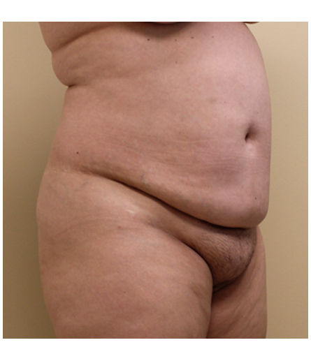 Pubic area before pubic lift, three-quarter view — Dr. Rudderman, Atlanta.