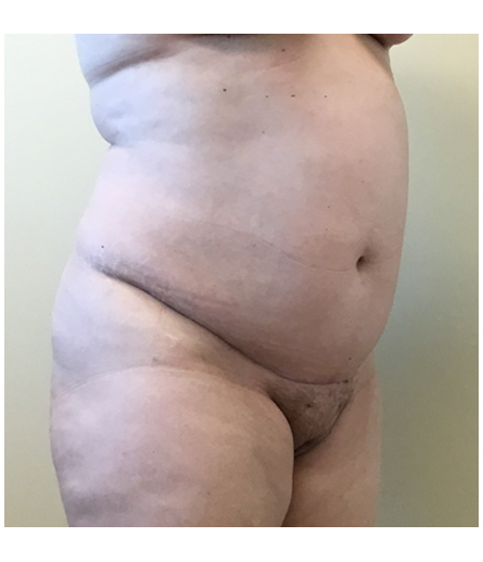 Pubic area after pubic lift, three-quarter view — Dr. Rudderman, Atlanta.