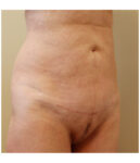 Pubic area after pubic lift, three-quarter view — Dr. Rudderman, Atlanta.