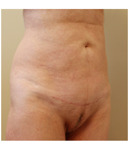 Pubic area after pubic lift, three-quarter view — Dr. Rudderman, Atlanta.