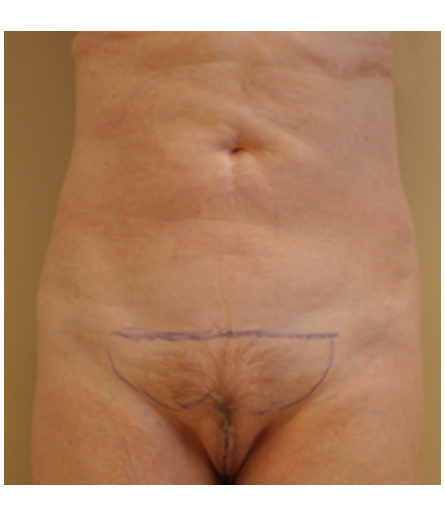Pubic area with pre-surgical markings before pubic lift, front view — Dr. Rudderman, Atlanta.